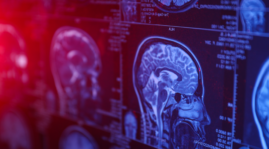 Stres beyni de etkiliyor